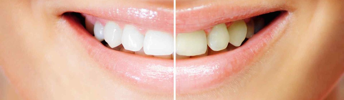 How whitening strips can damage your teeth